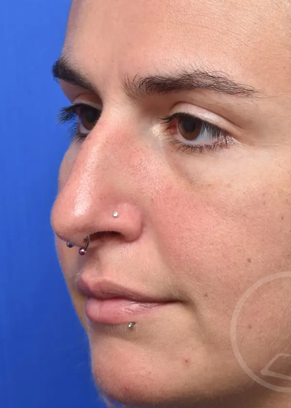 Plastic Surgery Before and After Pictures in Jacksonville, FL - Garcia Facial Plastic Surgery