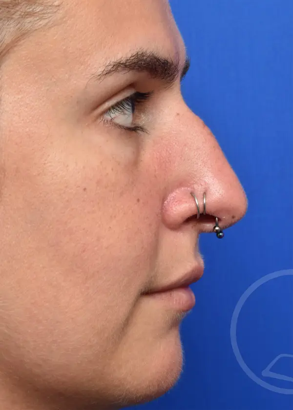 Plastic Surgery Before and After Pictures in Jacksonville, FL - Garcia Facial Plastic Surgery