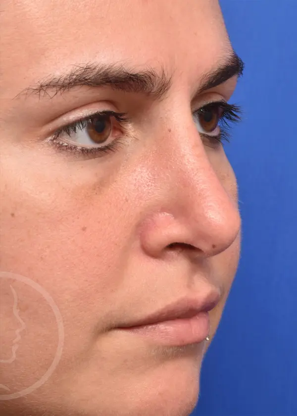 Plastic Surgery Before and After Pictures in Jacksonville, FL - Garcia Facial Plastic Surgery