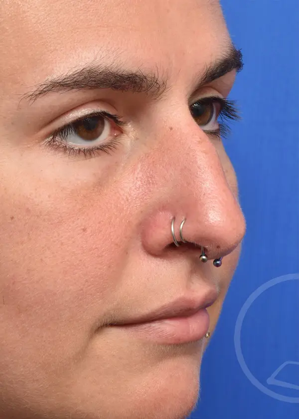 Plastic Surgery Before and After Pictures in Jacksonville, FL - Garcia Facial Plastic Surgery