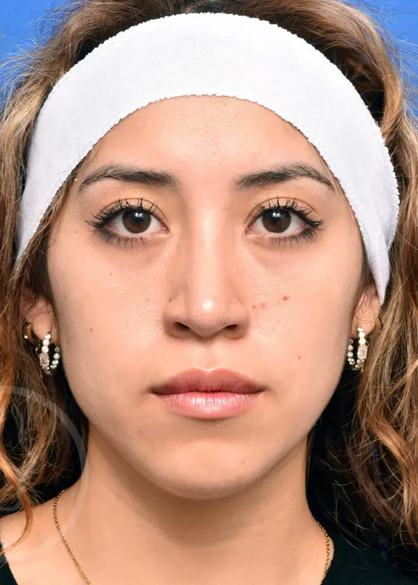 Plastic Surgery Before and After Pictures in Jacksonville, FL - Garcia Facial Plastic Surgery