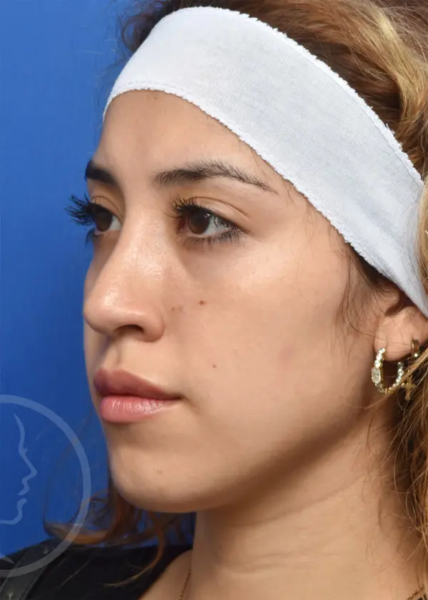 Plastic Surgery Before and After Pictures in Jacksonville, FL - Garcia Facial Plastic Surgery