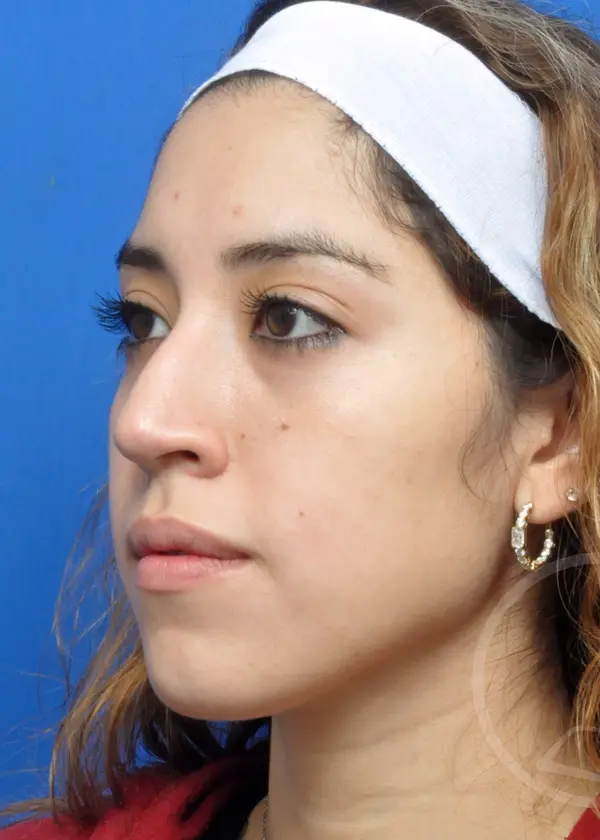 Plastic Surgery Before and After Pictures in Jacksonville, FL - Garcia Facial Plastic Surgery