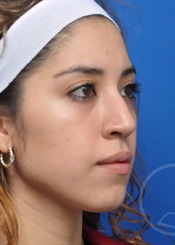 Plastic Surgery Before and After Pictures in Jacksonville, FL - Garcia Facial Plastic Surgery