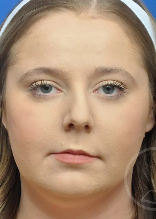 Plastic Surgery Before and After Pictures in Jacksonville, FL - Garcia Facial Plastic Surgery