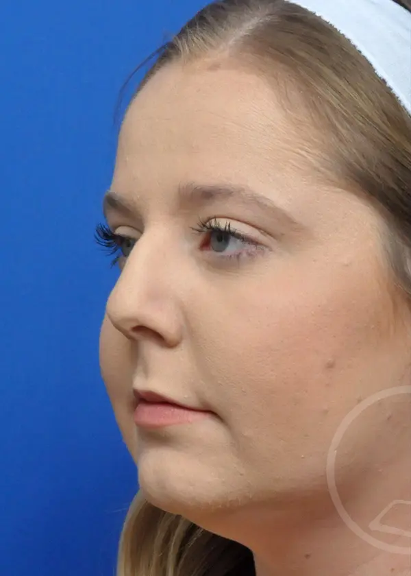 Plastic Surgery Before and After Pictures in Jacksonville, FL - Garcia Facial Plastic Surgery