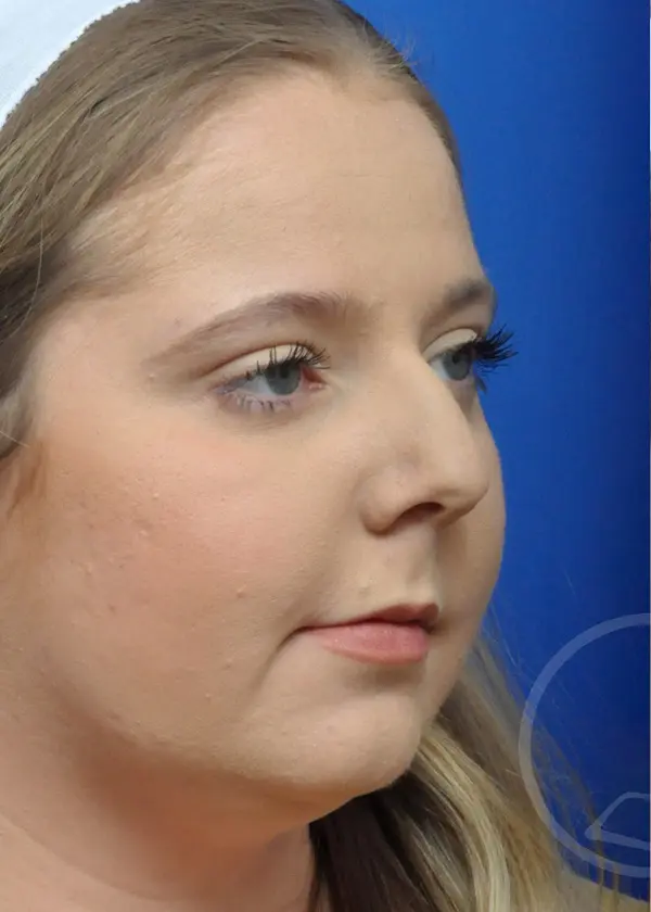 Plastic Surgery Before and After Pictures in Jacksonville, FL - Garcia Facial Plastic Surgery