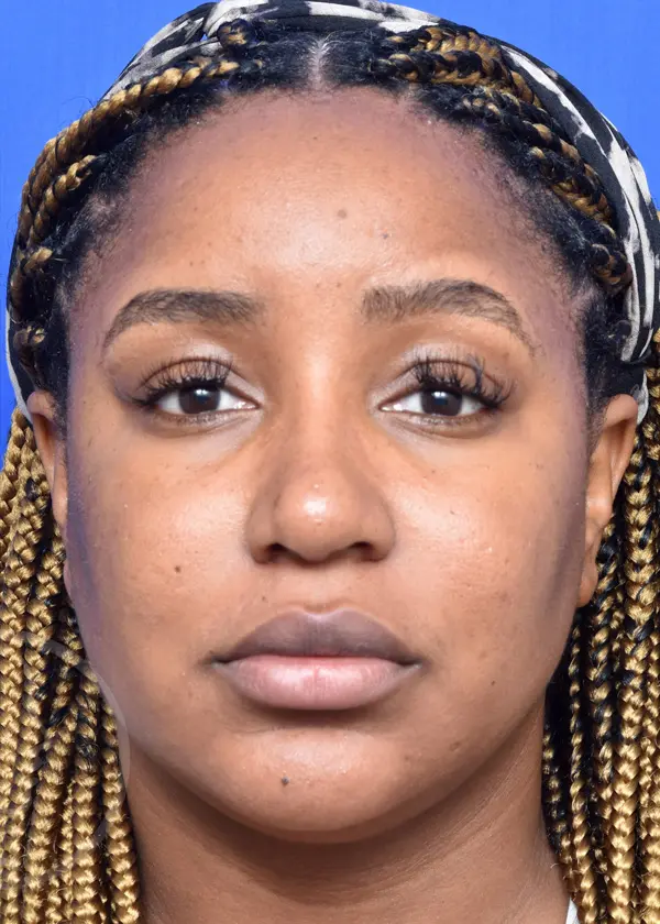 Plastic Surgery Before and After Pictures in Jacksonville, FL - Garcia Facial Plastic Surgery