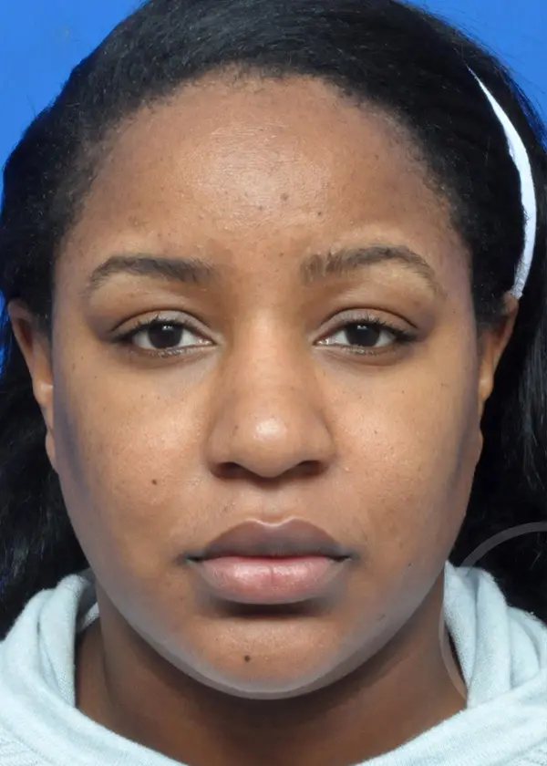 Plastic Surgery Before and After Pictures in Jacksonville, FL - Garcia Facial Plastic Surgery