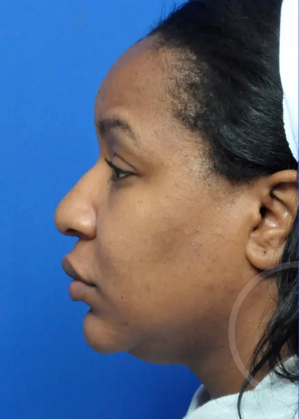 Plastic Surgery Before and After Pictures in Jacksonville, FL - Garcia Facial Plastic Surgery