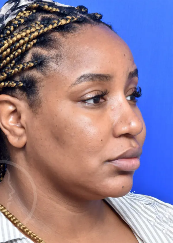 Plastic Surgery Before and After Pictures in Jacksonville, FL - Garcia Facial Plastic Surgery