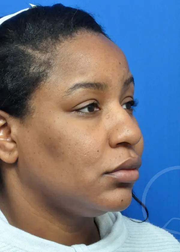 Plastic Surgery Before and After Pictures in Jacksonville, FL - Garcia Facial Plastic Surgery