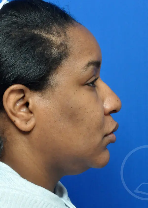 Plastic Surgery Before and After Pictures in Jacksonville, FL - Garcia Facial Plastic Surgery