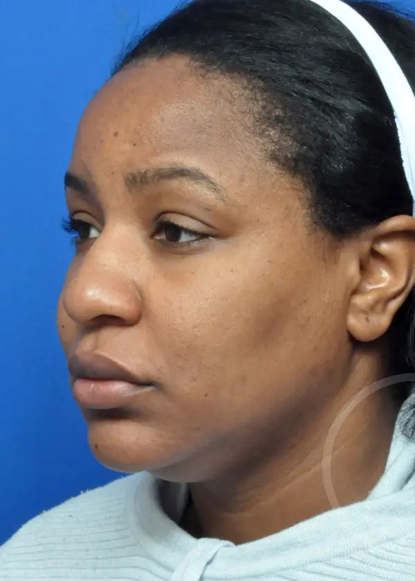 Plastic Surgery Before and After Pictures in Jacksonville, FL - Garcia Facial Plastic Surgery