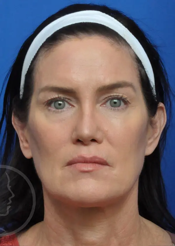 Plastic Surgery Before and After Pictures in Jacksonville, FL - Garcia Facial Plastic Surgery