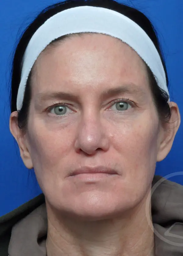 Plastic Surgery Before and After Pictures in Jacksonville, FL - Garcia Facial Plastic Surgery