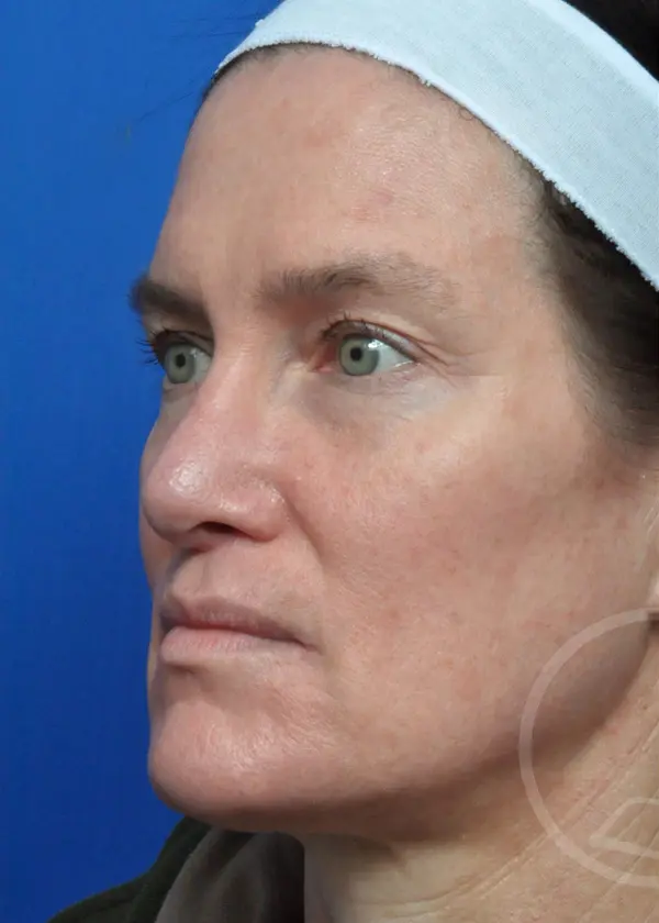 Plastic Surgery Before and After Pictures in Jacksonville, FL - Garcia Facial Plastic Surgery