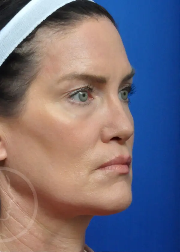 Plastic Surgery Before and After Pictures in Jacksonville, FL - Garcia Facial Plastic Surgery