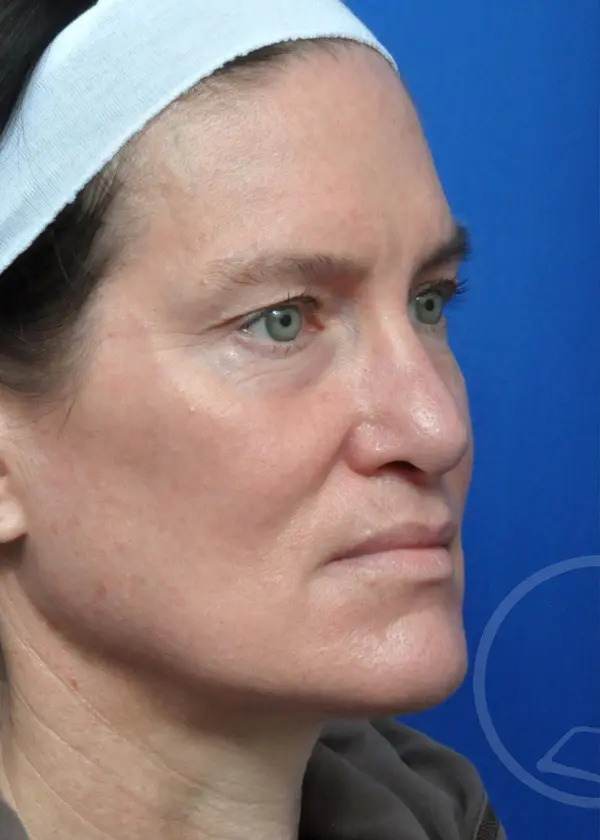 Plastic Surgery Before and After Pictures in Jacksonville, FL - Garcia Facial Plastic Surgery