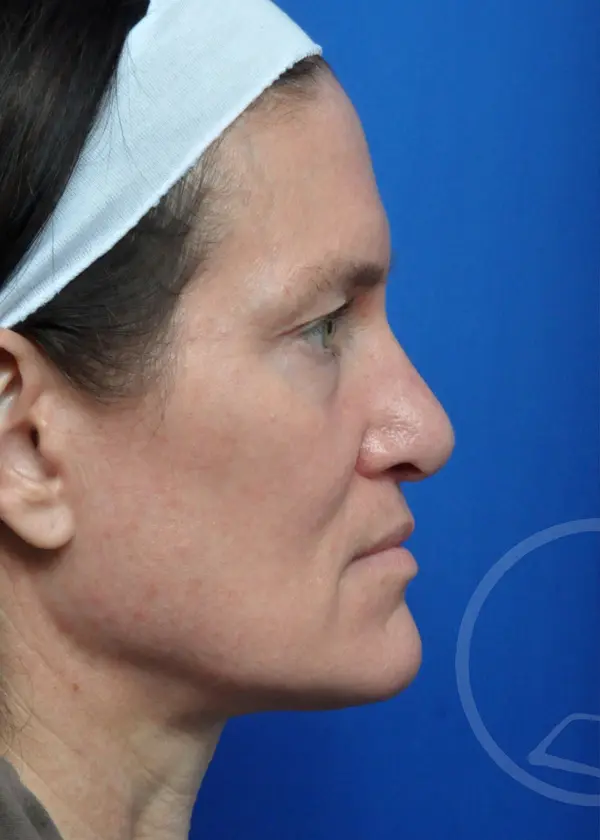 Plastic Surgery Before and After Pictures in Jacksonville, FL - Garcia Facial Plastic Surgery