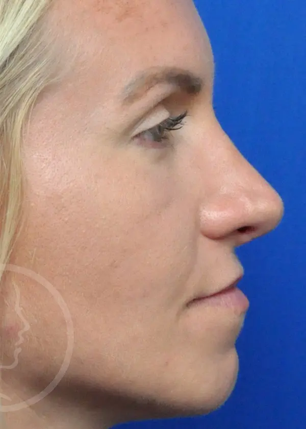 Plastic Surgery Before and After Pictures in Jacksonville, FL - Garcia Facial Plastic Surgery