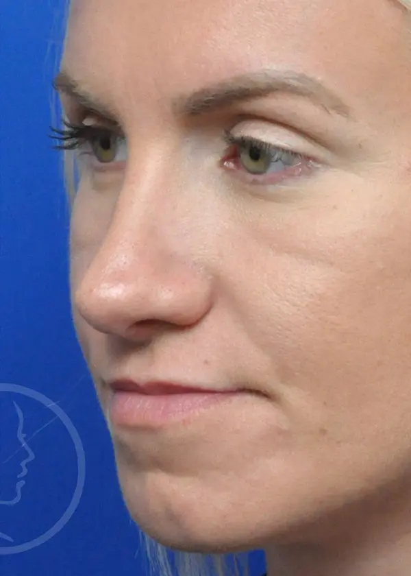 Plastic Surgery Before and After Pictures in Jacksonville, FL - Garcia Facial Plastic Surgery