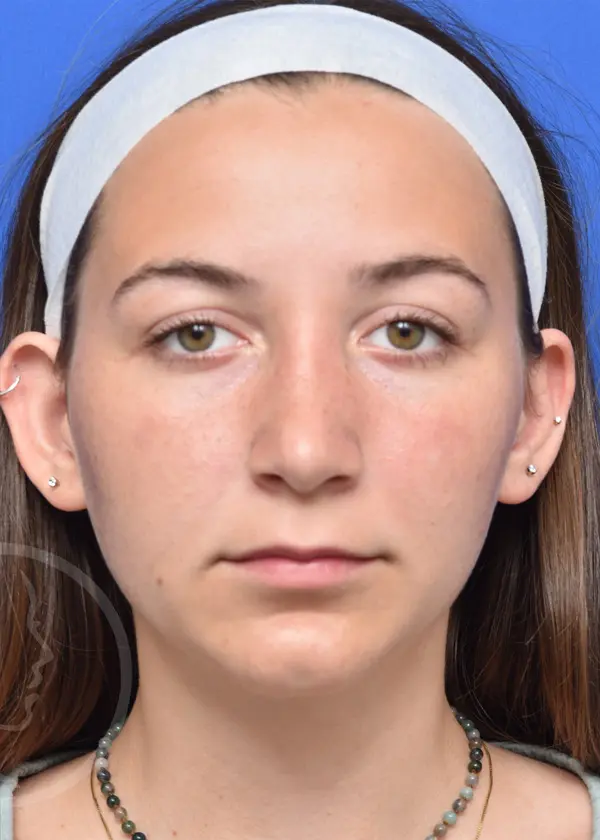 Plastic Surgery Before and After Pictures in Jacksonville, FL - Garcia Facial Plastic Surgery