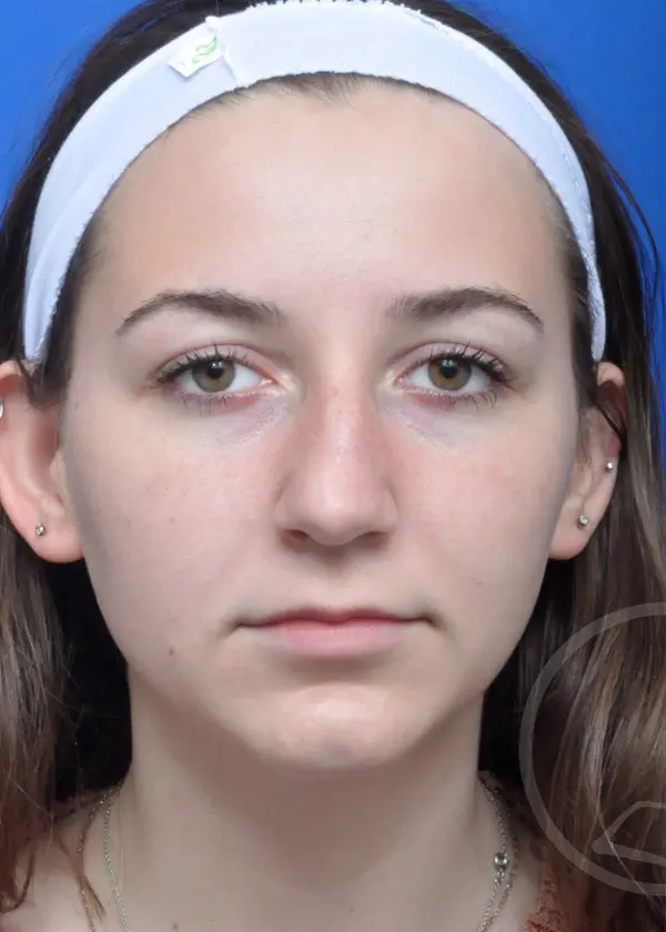 Plastic Surgery Before and After Pictures in Jacksonville, FL - Garcia Facial Plastic Surgery