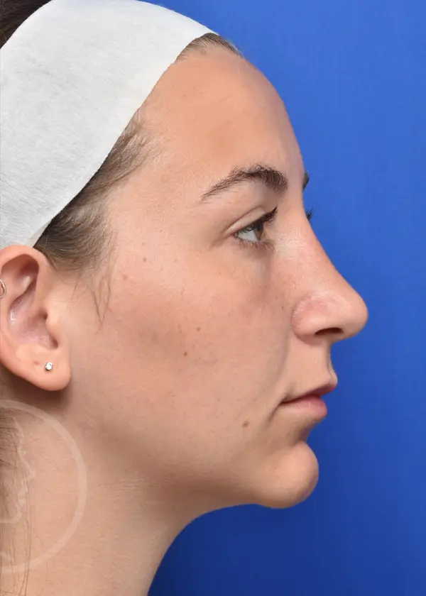 Plastic Surgery Before and After Pictures in Jacksonville, FL - Garcia Facial Plastic Surgery