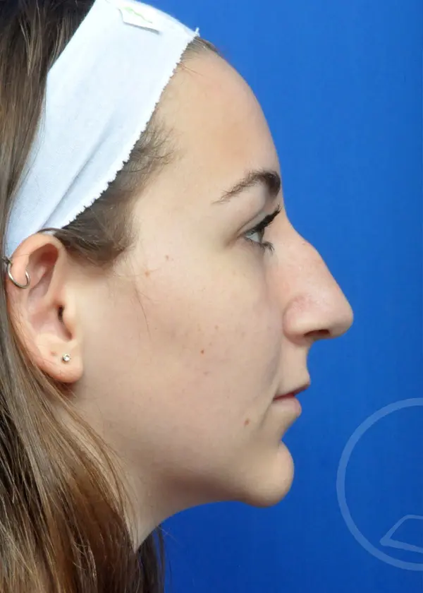 Plastic Surgery Before and After Pictures in Jacksonville, FL - Garcia Facial Plastic Surgery
