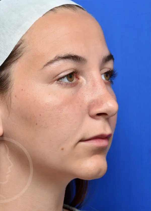 Plastic Surgery Before and After Pictures in Jacksonville, FL - Garcia Facial Plastic Surgery