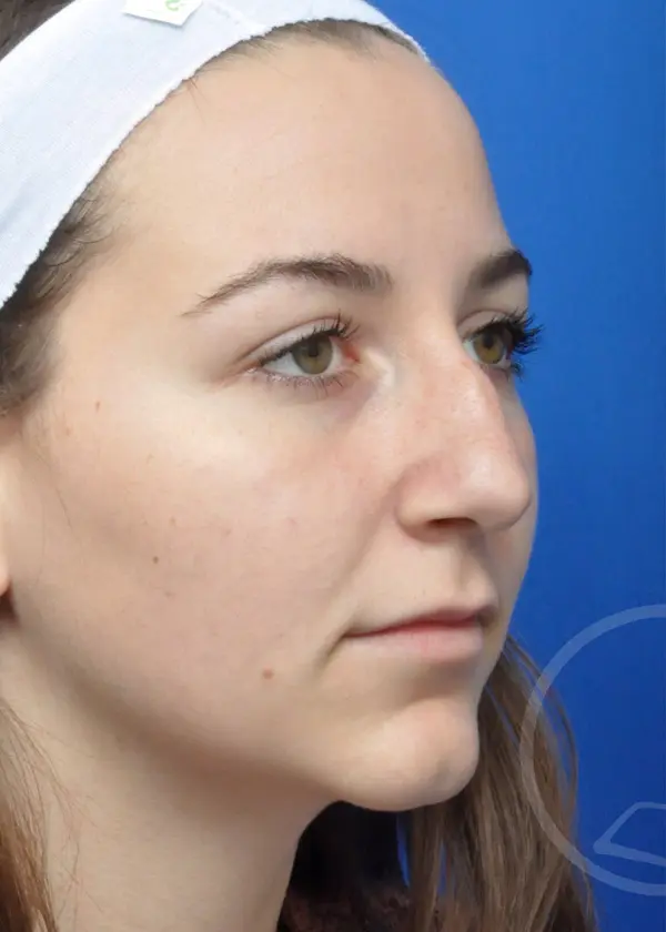 Plastic Surgery Before and After Pictures in Jacksonville, FL - Garcia Facial Plastic Surgery