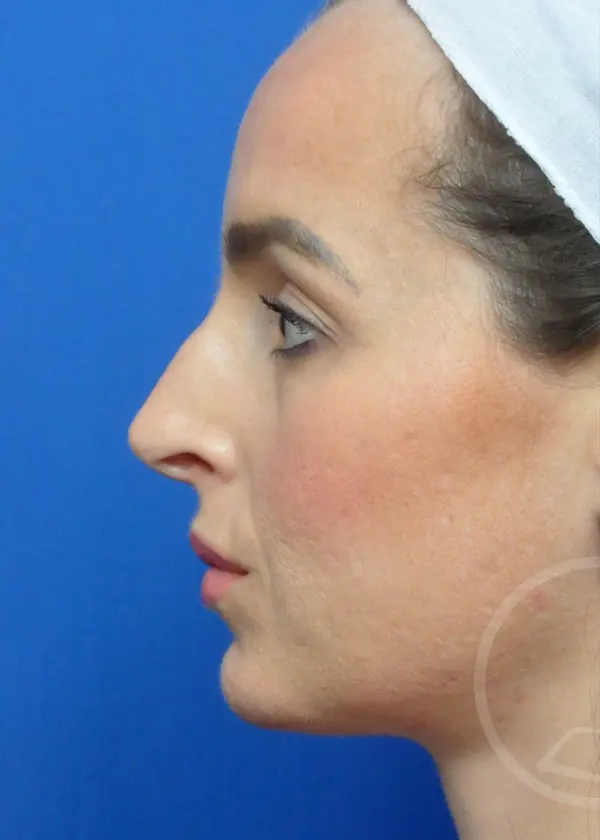 Plastic Surgery Before and After Pictures in Jacksonville, FL - Garcia Facial Plastic Surgery