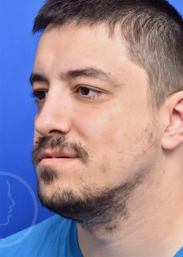 Plastic Surgery Before and After Pictures in Jacksonville, FL - Garcia Facial Plastic Surgery