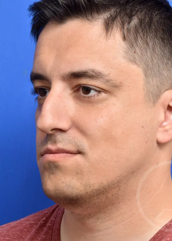 Plastic Surgery Before and After Pictures in Jacksonville, FL - Garcia Facial Plastic Surgery