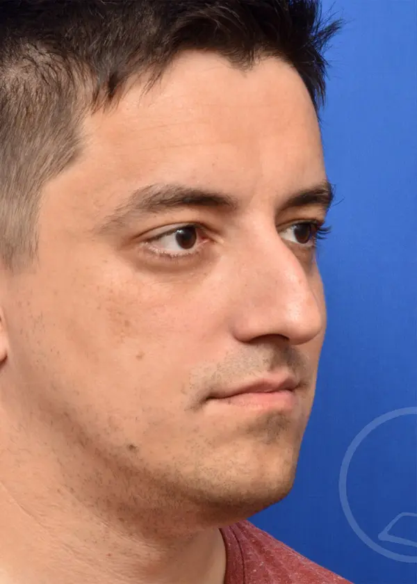 Plastic Surgery Before and After Pictures in Jacksonville, FL - Garcia Facial Plastic Surgery