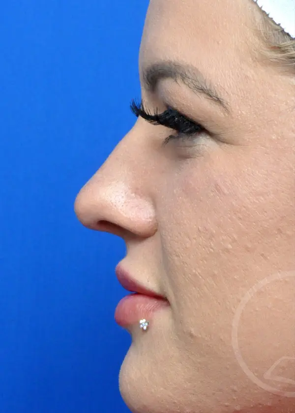 Plastic Surgery Before and After Pictures in Jacksonville, FL - Garcia Facial Plastic Surgery