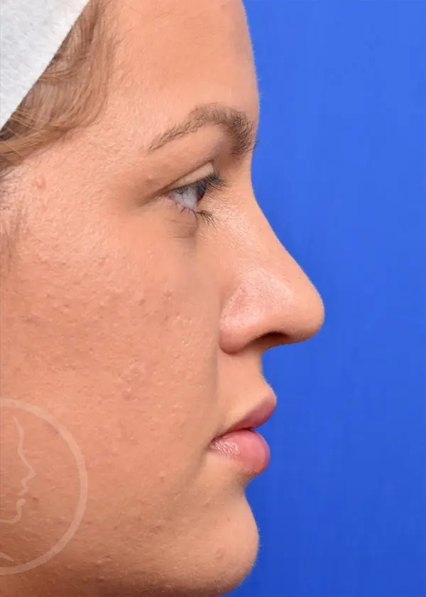 Plastic Surgery Before and After Pictures in Jacksonville, FL - Garcia Facial Plastic Surgery