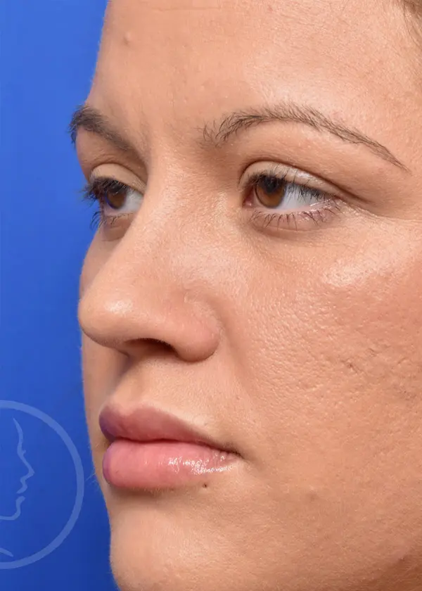 Plastic Surgery Before and After Pictures in Jacksonville, FL - Garcia Facial Plastic Surgery