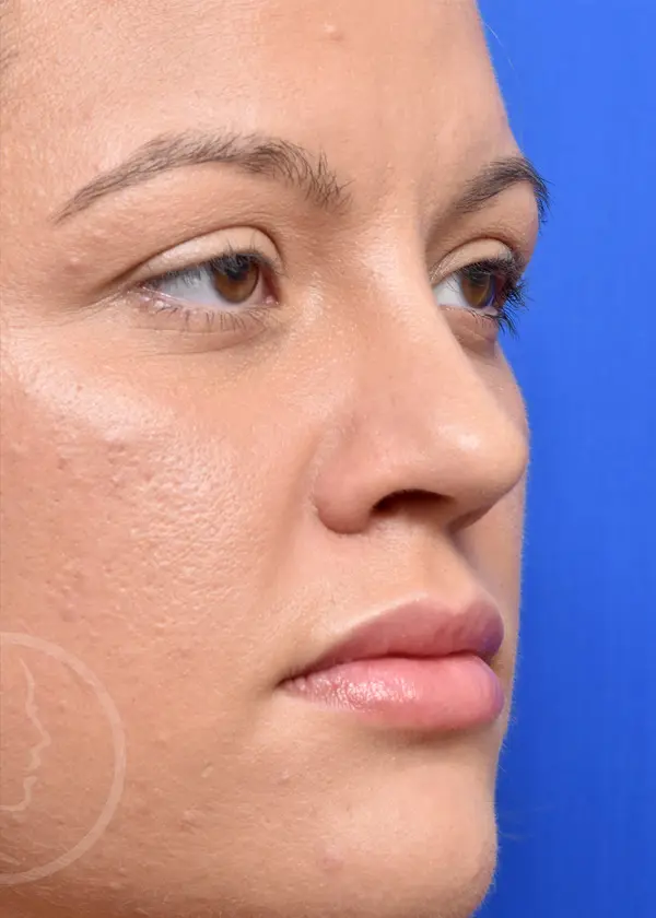 Plastic Surgery Before and After Pictures in Jacksonville, FL - Garcia Facial Plastic Surgery