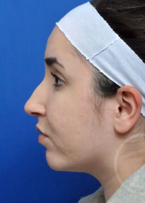 Plastic Surgery Before and After Pictures in Jacksonville, FL - Garcia Facial Plastic Surgery