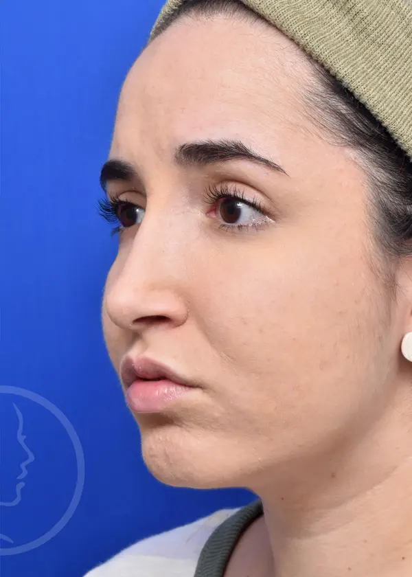 Plastic Surgery Before and After Pictures in Jacksonville, FL - Garcia Facial Plastic Surgery