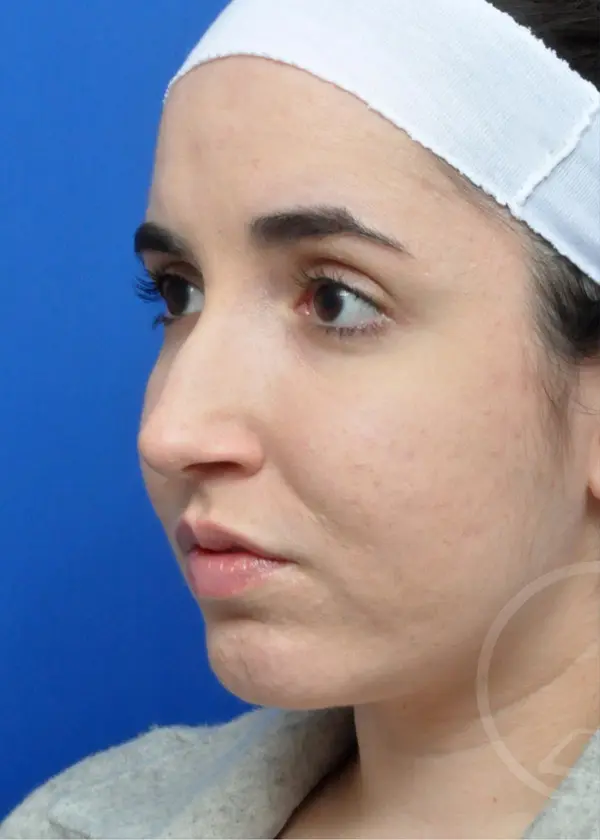 Plastic Surgery Before and After Pictures in Jacksonville, FL - Garcia Facial Plastic Surgery