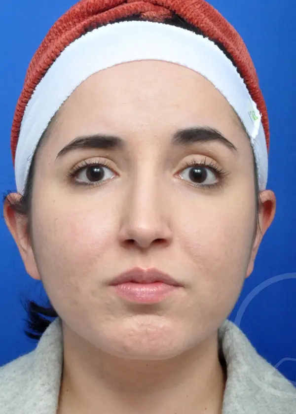 Plastic Surgery Before and After Pictures in Jacksonville, FL - Garcia Facial Plastic Surgery