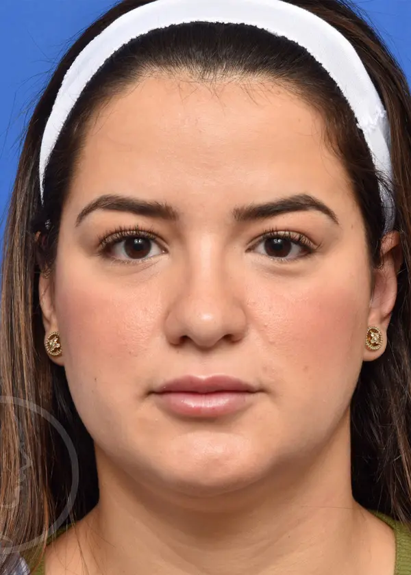 Plastic Surgery Before and After Pictures in Jacksonville, FL - Garcia Facial Plastic Surgery