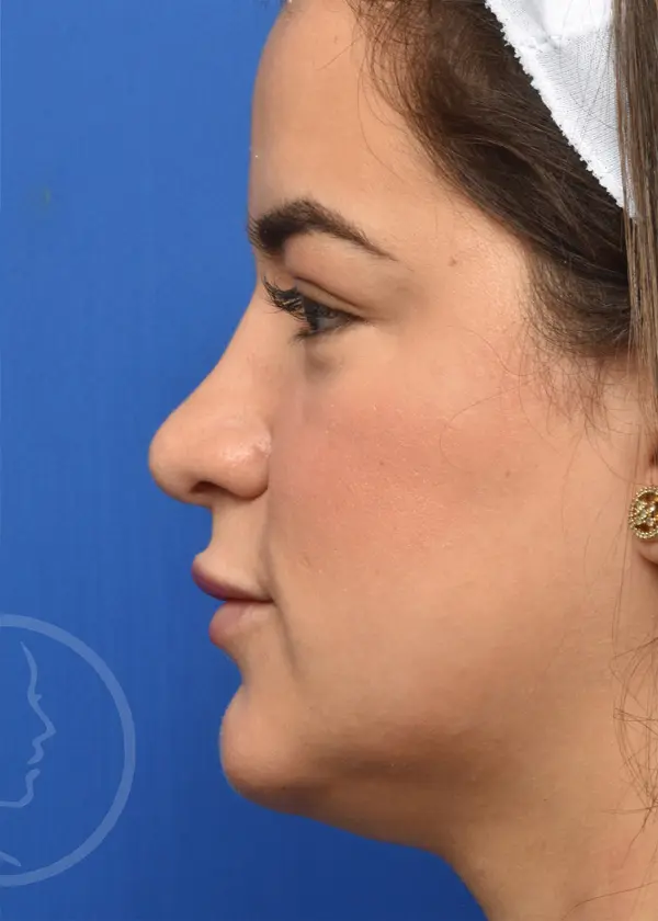 Plastic Surgery Before and After Pictures in Jacksonville, FL - Garcia Facial Plastic Surgery