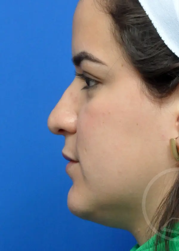 Plastic Surgery Before and After Pictures in Jacksonville, FL - Garcia Facial Plastic Surgery