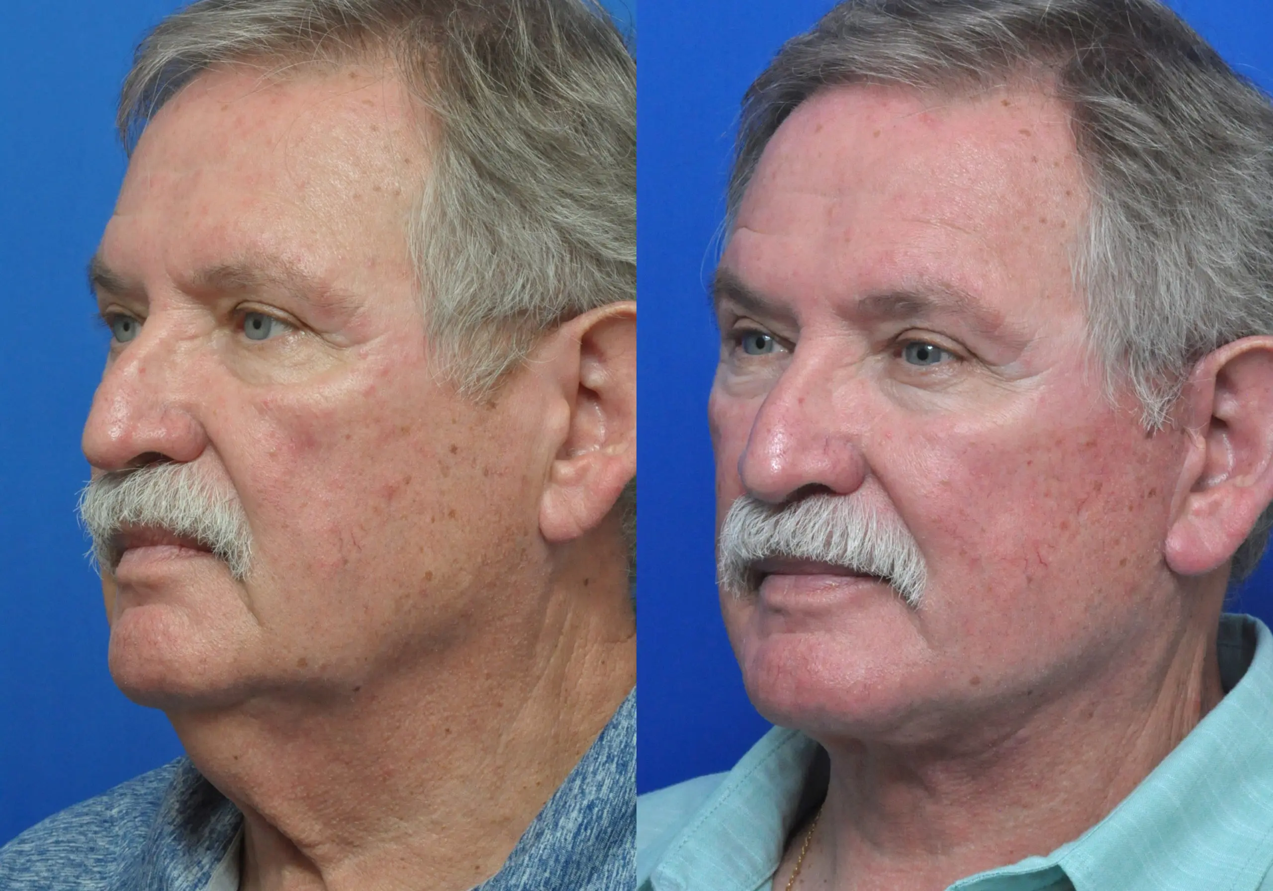 Facelift Journeys - Garcia Facial Plastic Surgery