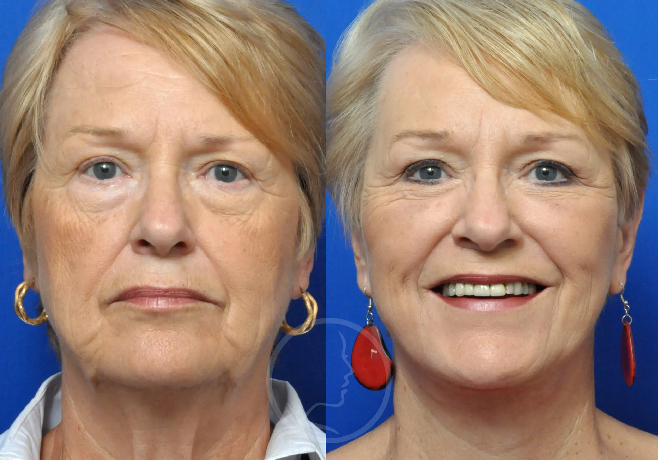 Brow Lift in Jacksonville, FL