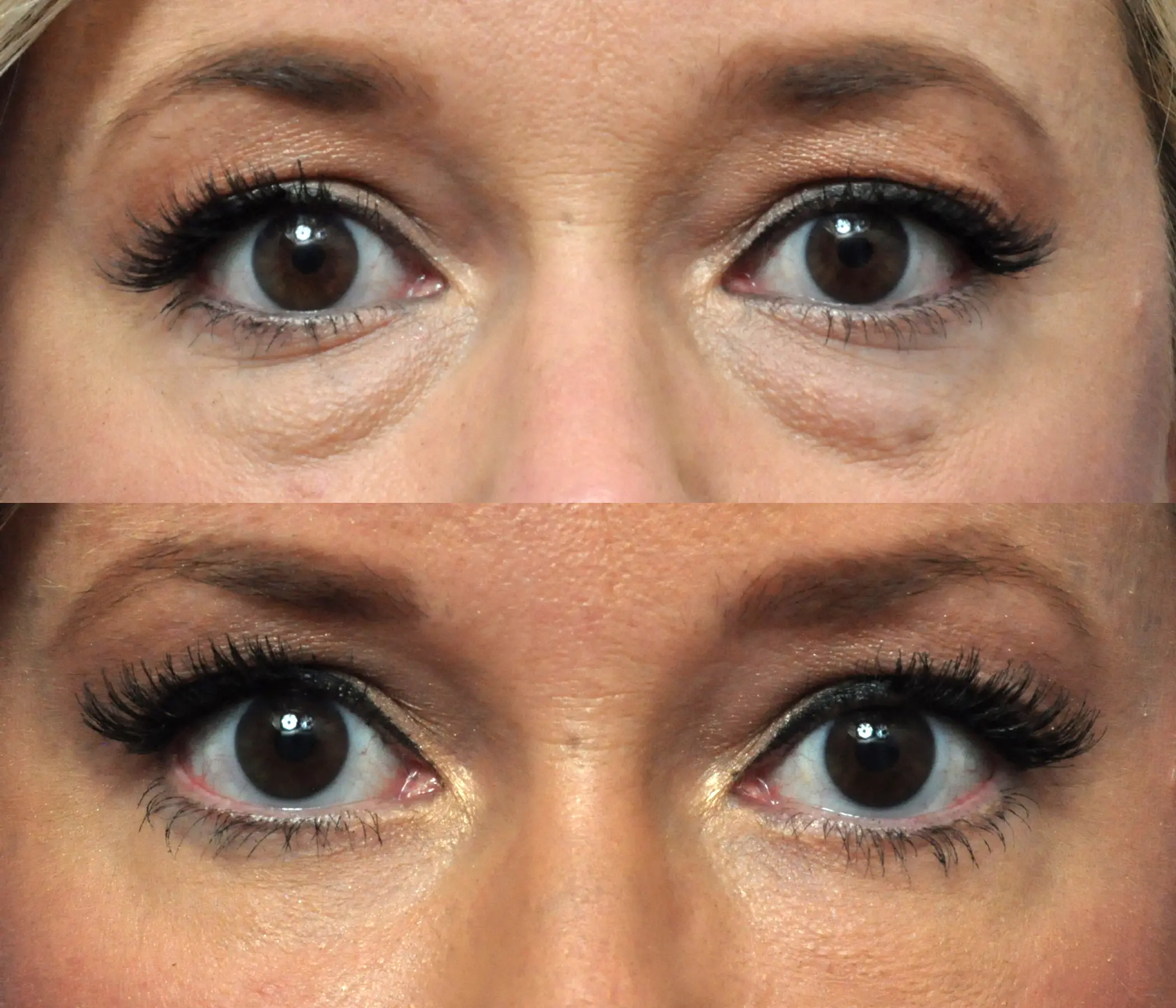 Eyelid Surgery in Jacksonville, FL